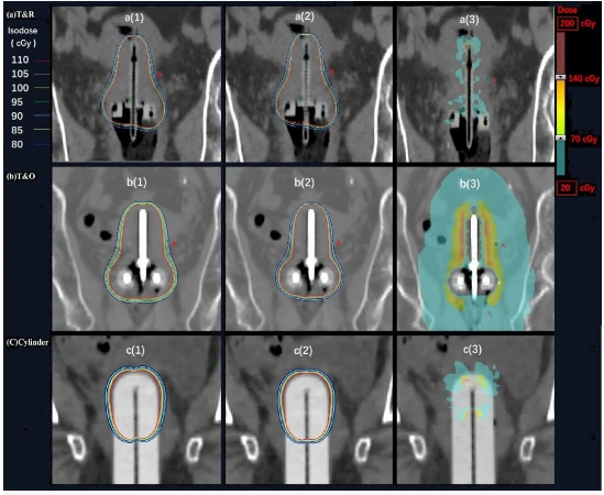 Acuros BV算法能更好应对后装治疗中常见的组织较大的不均匀性