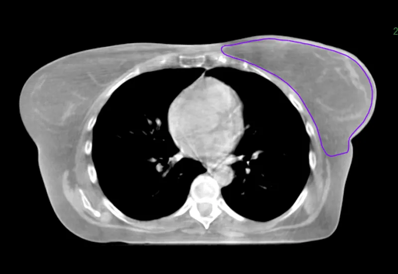 Hypersight breast and body