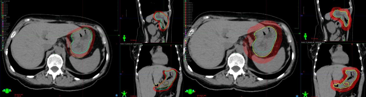 Image description goes hereCBCTs from treatment session 1
