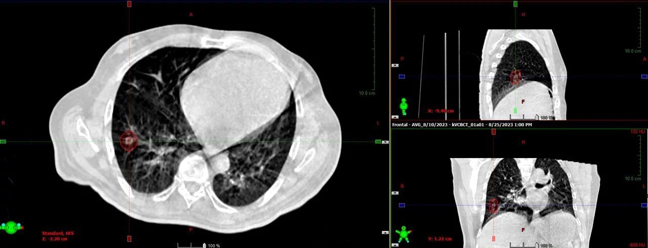HyperSight cone-beam CT from a two-isocenter plan for treating oligometastatic lung lesions.