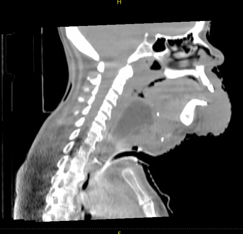 Hypersight head and neck
