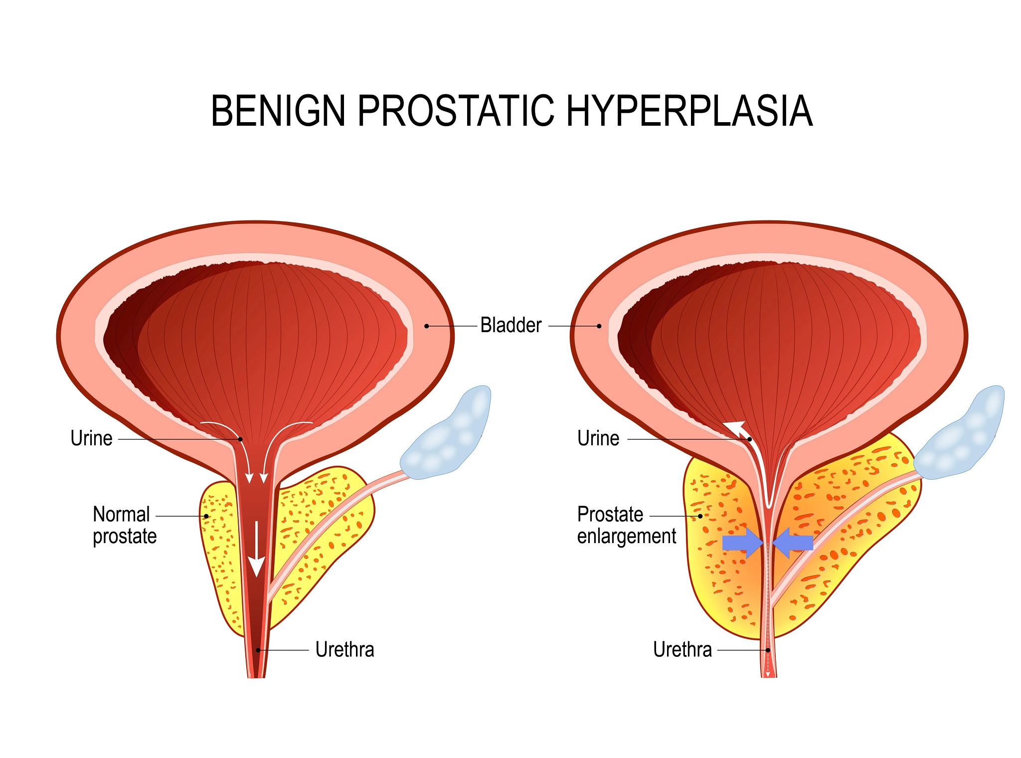 Benign prostatic hyperplasia 