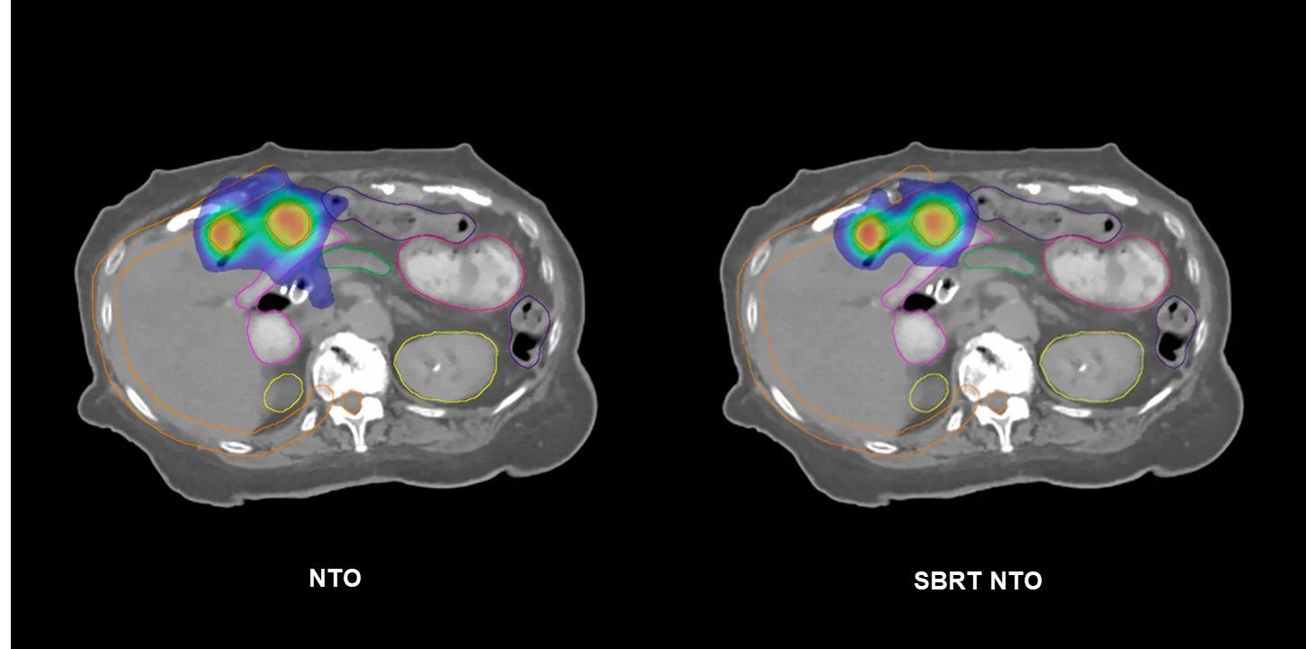 NTO/SBRT NTO Comparison