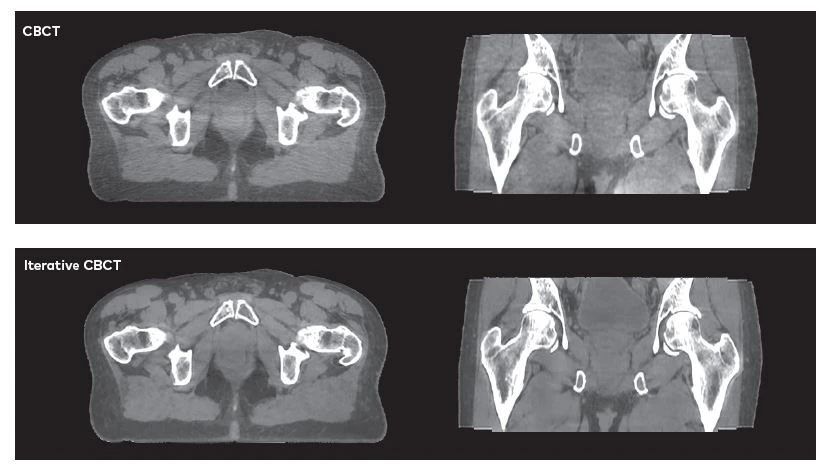 Varian’s Iterative Cone-Beam Computed Tomography (iCBCT):  Clear Soft Tissue Visualization for Precision Radiotherapy
