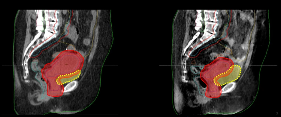 CT/CBCT-guided Online Adaptive Radiotherapy: A Publishing Competition
