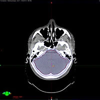 Personalizing Care Through Adaptive Radiotherapy
