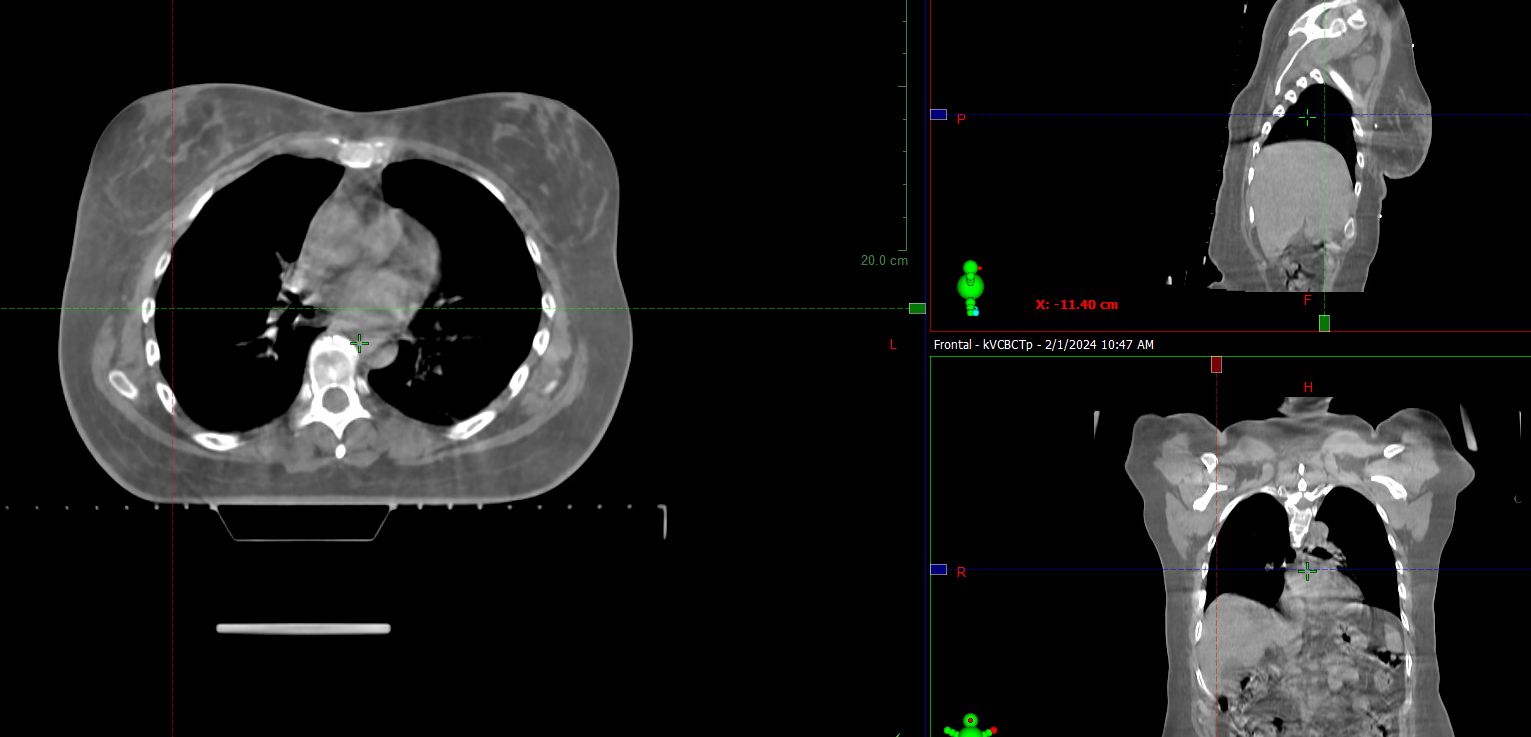 HyperSight CBCT for planning scan of the thorax and upper abdomen.