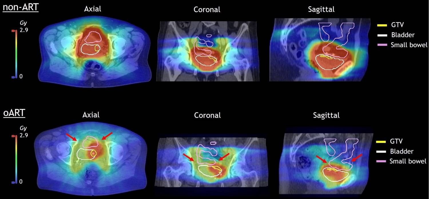 Non-adaptive vs adaptive dose to the small bowel
