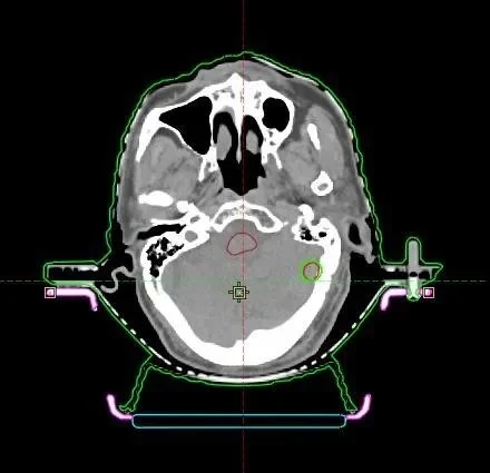 计划不烦“脑”，质控要抓好 | 广州中医药大学金沙洲医院脑转移瘤放疗经验分享
