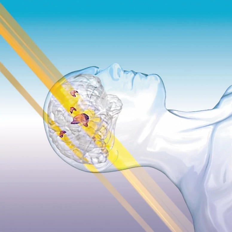 Around the World with HyperArc Radiosurgery for Benign Indications