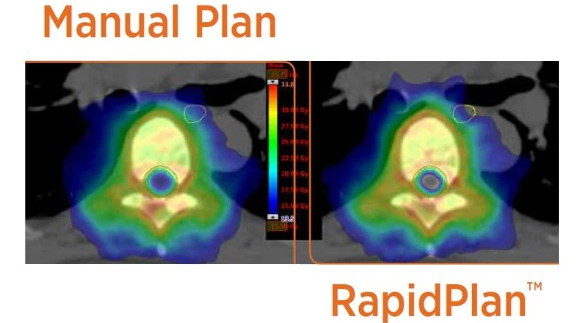 Research Demonstrates RapidPlan Treatment Planning Can Improve Plan Quality