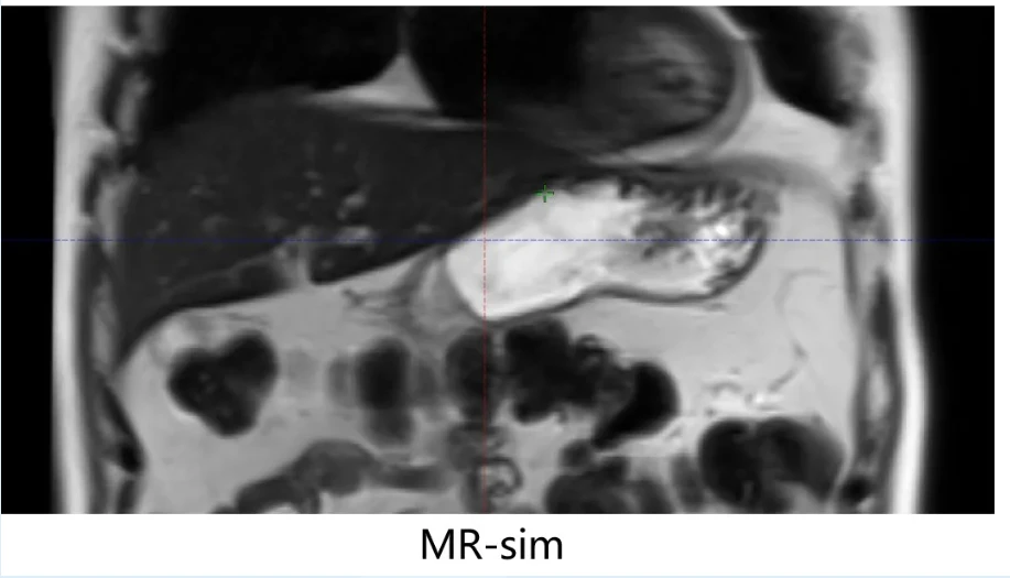 全流程管理在胃肠道肿瘤放疗运动管理中的应用