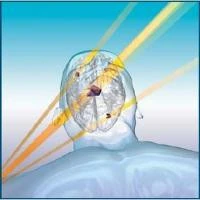 HyperArc High-Definition Radiosurgery: Enabling Fast, Accurate Treatment of Multiple Brain Mets