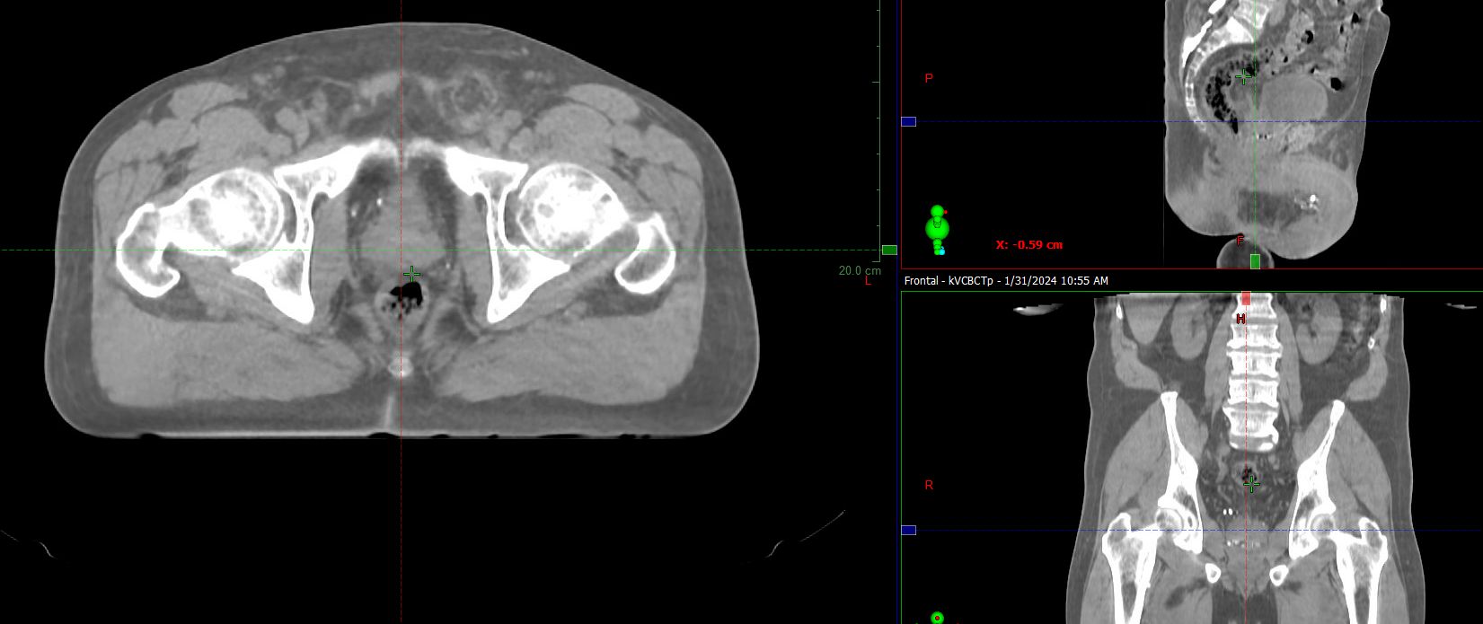 HyperSight cone-beam CT for planning of the pelvis with implanted fiducials, generated using metal artifact reduction capability.