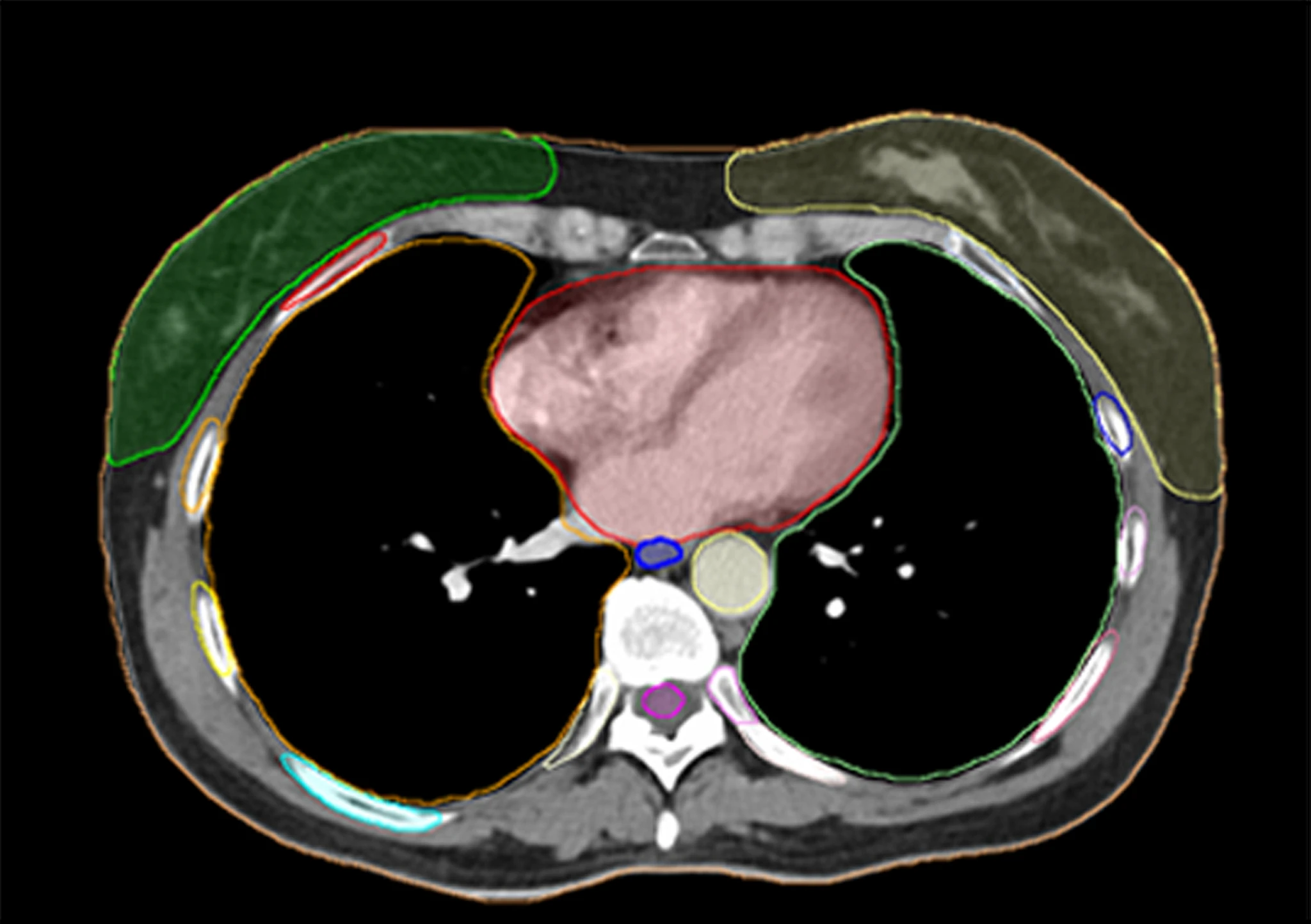 AI-Driven Contouring Software Integrated with Varian’s Treatment Planning Services