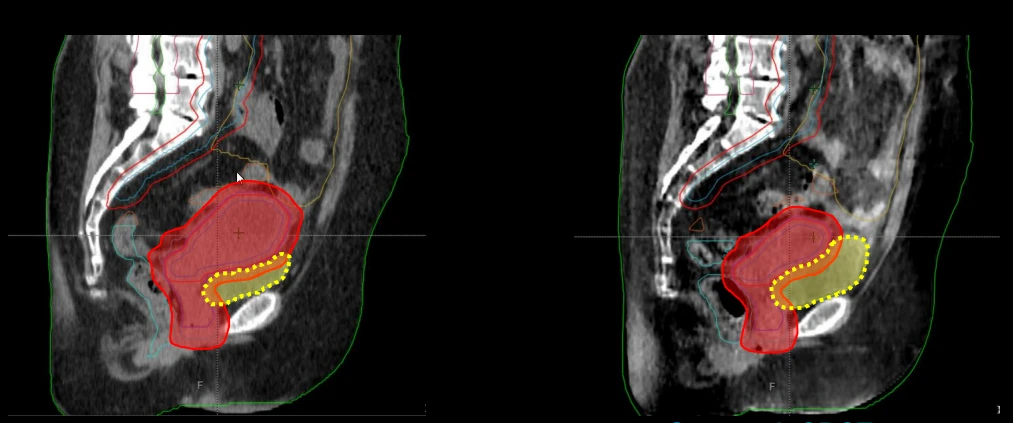 Varian-Sponsored CT or CBCT Guided Online Adaptive Radiotherapy Clinical Case Reports Publishing Competition Presented by The Cureus Journal of Medical Science