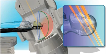 HyperArc Technology for High-Definition Radiotherapy and Radiosurgery
