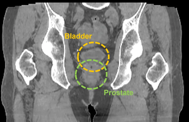 Hypersight prostate